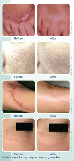 Scar treatment